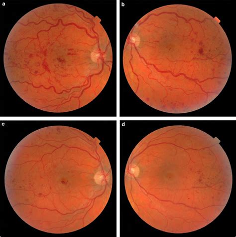 Dilated Fundal Examination Of Patient No 1 Showed Tortuous Dilated