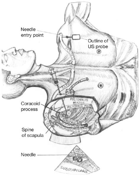 Figure 1 From Ultrasound Guided Infraclavicular Brachial Plexus Block