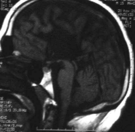 T1 Weighted Sagittal Mri Sequence Showing Complete Agenesis Of The