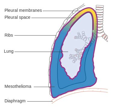 Mesothelioma can occur either in the lung or in the abdominal cavity. Learn: Pleural Mesothelioma | America Daily Post