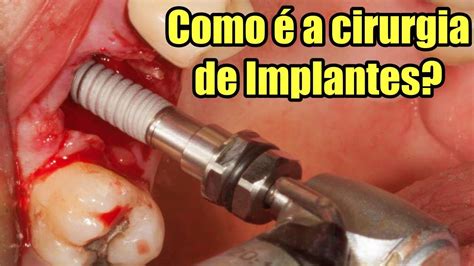 Cirurgia De Implante Dentário Como Funciona Implantedentario Youtube
