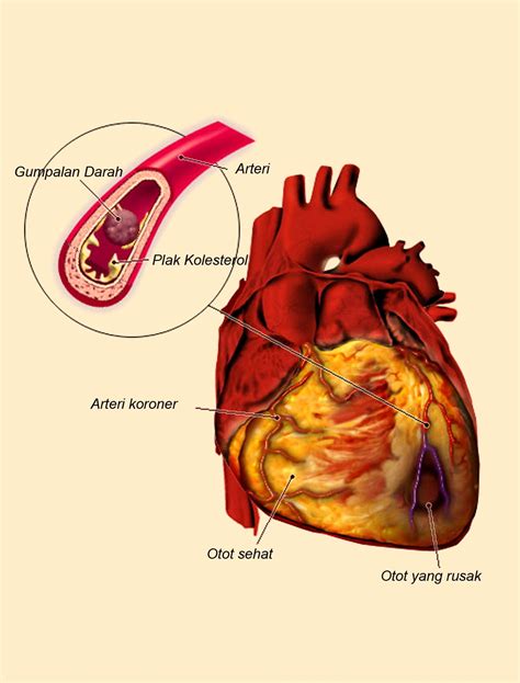 Itulah cara mengatasi jantung berdebar, semoga bermanfaat dan semoga jantung kamu tejaga, sehat selalu, serta terhindar dari segala macam penyakit. Pengalaman Belajar Praktika Keperawatan: Hal. 7 ebook pdf ...