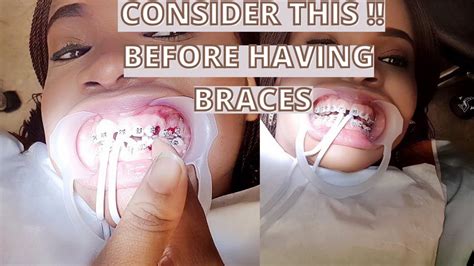 Advantages And Disadvantages Of Tooth Braces Youtube