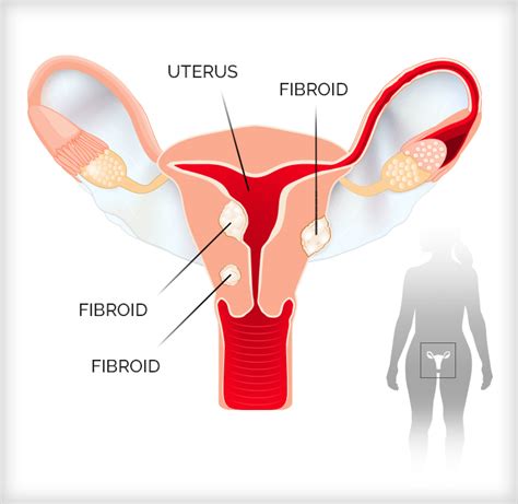 Fibroids Symptoms And Treatments