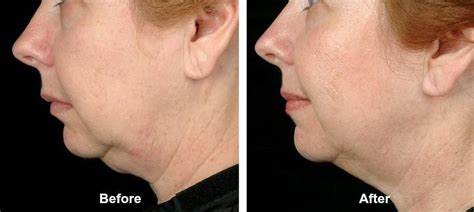 Thermage Neck Tightening Before And After About Face Skin Care