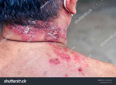 Raised Red Bumps Skin Rash Blisters Stock Photo 2154180263 Shutterstock