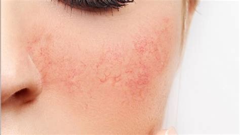 How To Treat Very Sensitive Skin Home Remedies That Actually Work ⬅️