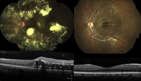 Current Management Of Coats Disease Survey Of Ophthalmology