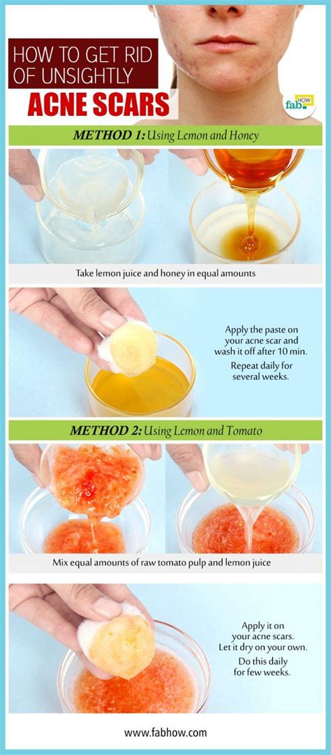 Ideal Tips About How To Get Rid Of Acne Scars Without Surgery - Waterask