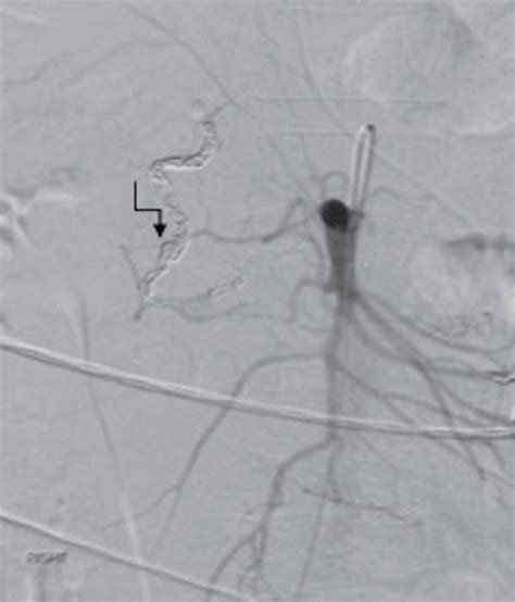 Postembolization Angiography Demonstrating Complete Stasis And
