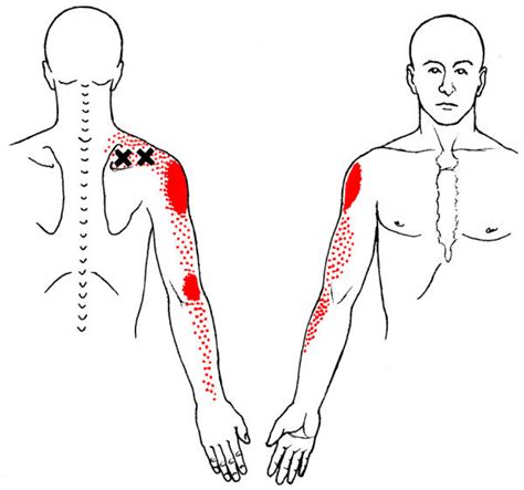 Referred Pain Pattern Red From Supraspinatus Muscle Mtrp