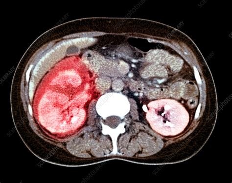 Kidney Damage CT Scan Stock Image M195 0200 Science Photo Library