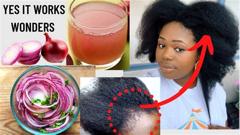 3 Best Ways To Use Red Onion For Faster Hair Growth And Thickening The