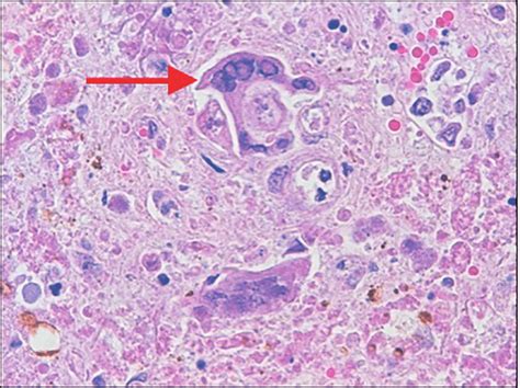 The Hepatocytes Arrow Show Multinucleation With Intranuclear Viral