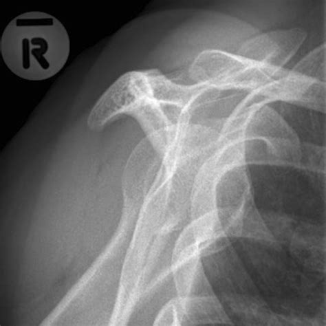 Radiographic Images Of The Humerus And Shoulder Scapular Y Lateral My