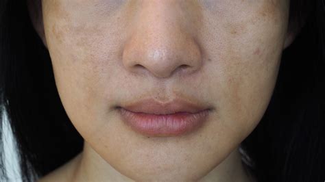 How To Treat Pregnancy Melasma Pregnancy Mask With Picosure Laser