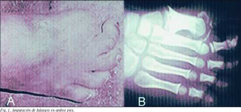 Anestesia Epidural A Un Ni O Con Fractura De F Mur E Insensibilidad