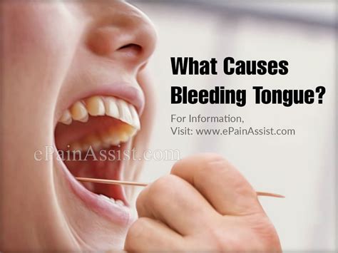 Warts On Tongue Treatment