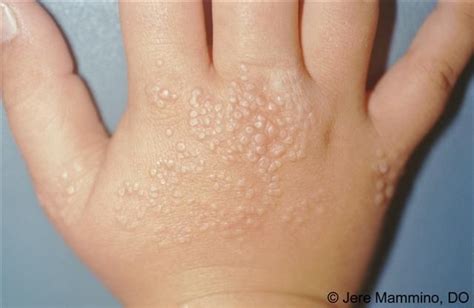 Lichen Nitidus Pinhead Size Nodules On Dorsum Of Hand American