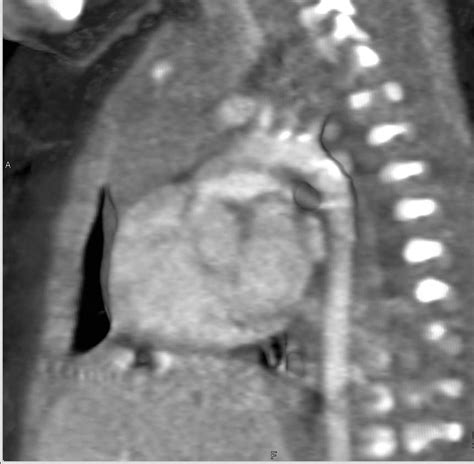 Coarctation Of The Aorta Sp Repair Vascular Case Studies Ctisus Ct