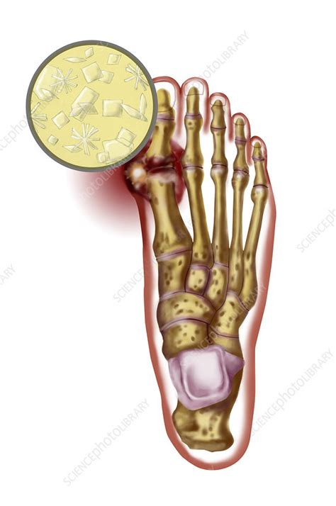 Foot With Gout Stock Image C0270718 Science Photo Library