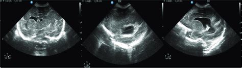 Cerebral Ultrasound Performed After Birth Cerebral Ultrasound