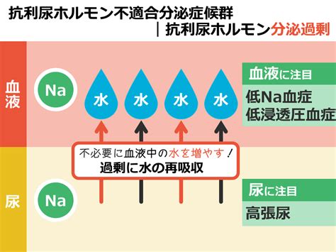 Background our study aimed to demonstrate the frequency of the syndrome of inappropriate adh secretion (siadh) and associated factors during the course of brucellosis in children and adolescents. 【臨床】SIADH/尿崩症 - SGSブログ