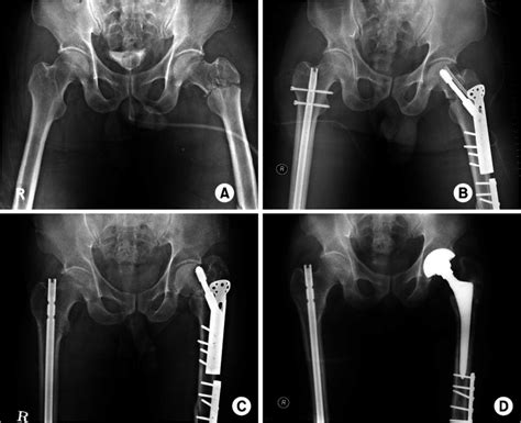 A Anteroposterior Radiograph Of Hip In A 56 Year Old Man Shows Left