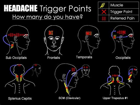 Headaches Mendez Chiropractic Center Massage Therapy Trigger Point Therapy Trigger Points