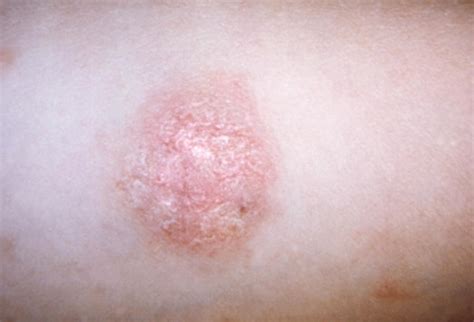 Common Rashes Not To Miss Slideshow