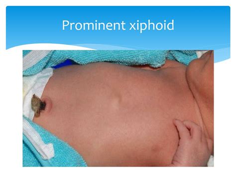 Xiphoid Process Baby