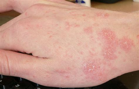 Scabies Rash What Is A Scabies Rash Hot Sex Picture
