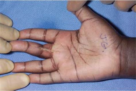 Principles Of Hand Incisions Musculoskeletal Key
