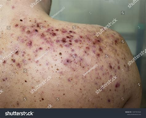 410 Severe Acne Images Stock Photos And Vectors Shutterstock