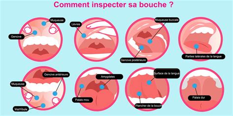 7 Symptômes Dalerte Dun Cancer De La Bouche