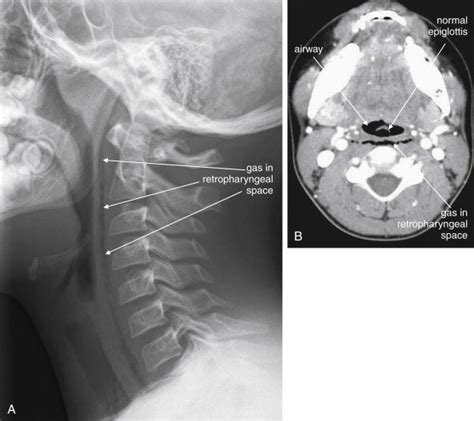 Retropharyngeal Space X Ray