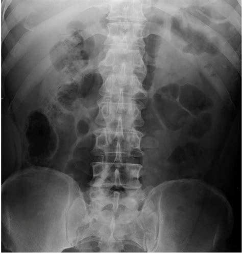 Strangulated Inguinal Hernia Presenting As Haemoperitoneum Bmj Case