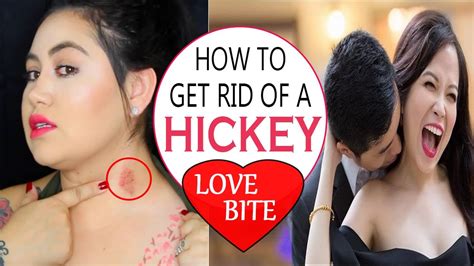 how to get rid of a hickey fast home remedies for love bite removal remove hickey fast