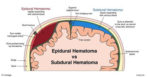 Subdural Hemorrhage Vs Subarachnoid Hemorrhage