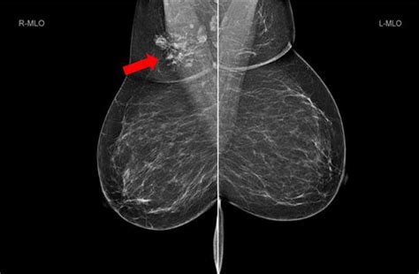 Bilateral Mammogram Shows Mixed Density Glandular Breast Tissue With No