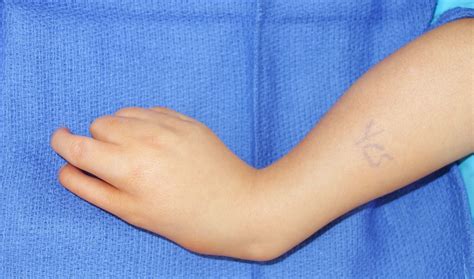 Wrist Deviation Congenital Hand And Arm Differences