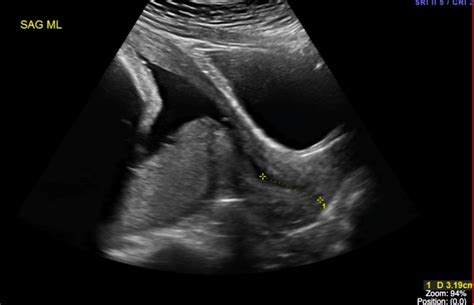 Grade 2 Placenta Ultrasound