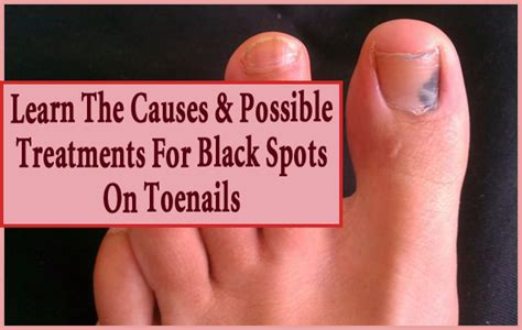 Black Spots On Toenails Black Spot On Toenail Toe Nails Black Toe Nails