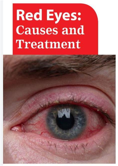 Red Eyes Causes And Treatment