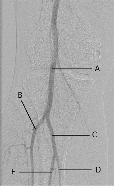 Digital Subtraction Angiography Of The Right Lower Leg The Bmj