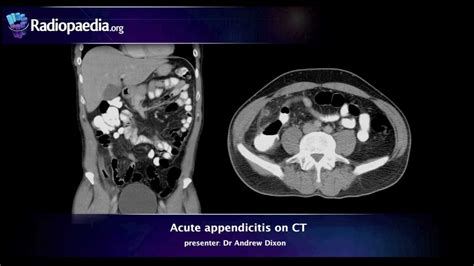 Appendicitis On Ct Scan