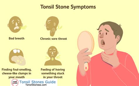 Are Tonsil Stones Good Or Bad 2022