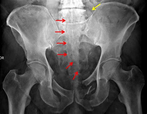 CaseStacks.com — Case #15 — Stable pelvic ring injury (LC I)