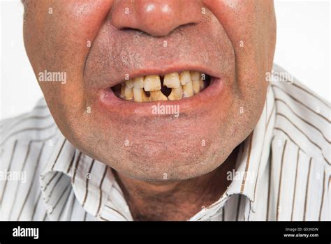 Guy With Bad Teeth