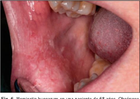 vacío síndrome Ceniza lesiones en cavidad oral ángulo Manhattan Cuyo
